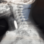 إنقاذ طفل تعرض لاختناق إثر ابتلاع عملة معدنية