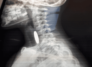 إنقاذ طفل تعرض لاختناق إثر ابتلاع عملة معدنية